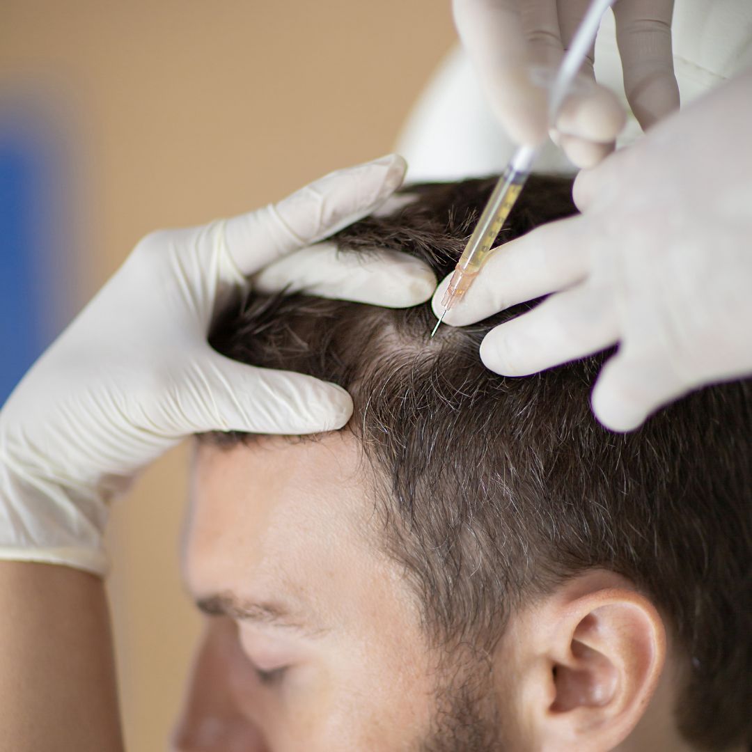 Advanced PRP hair treatment procedure in progress Manchester clinic Dawn
