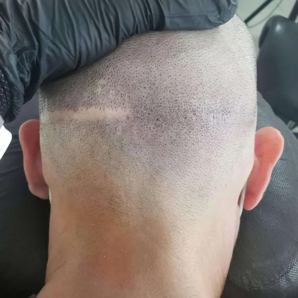 Professional scar camouflage scalp micropigmentation results Manchester clinic
