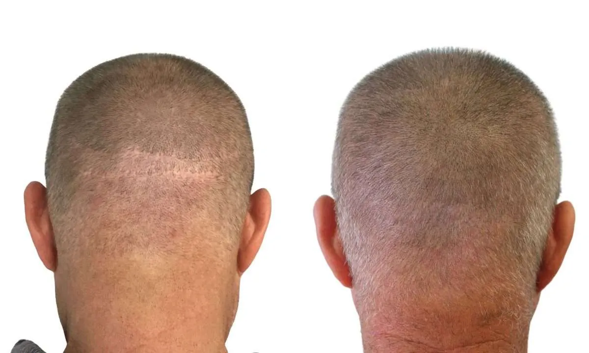 Hair transplant scar camouflage SMP before after Manchester specialist clinic