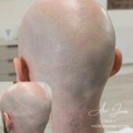 Hair transplant scar camouflage SMP before after Manchester specialist clinic