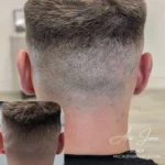 Hair transplant scar camouflage SMP before after Manchester specialist clinic