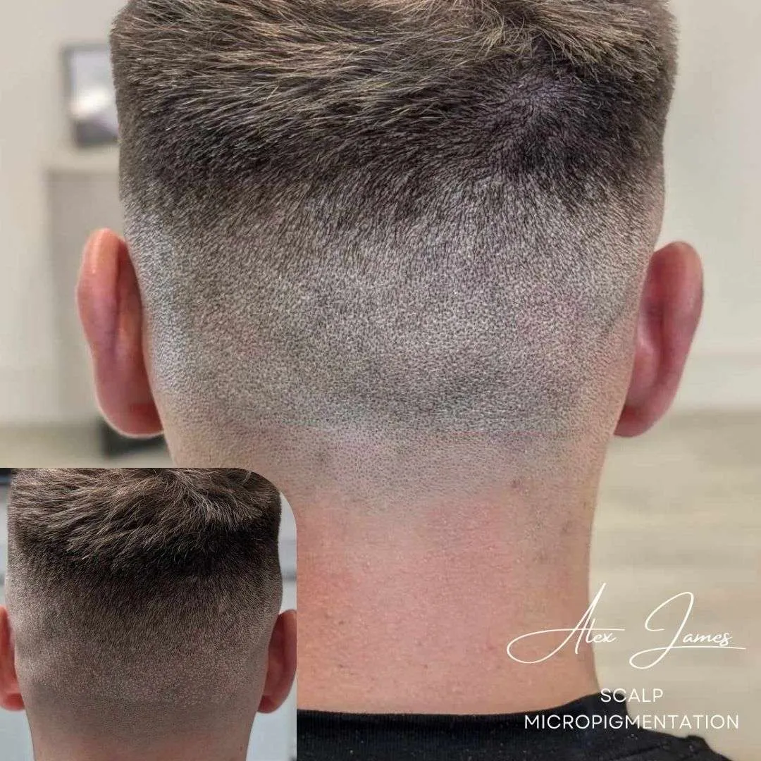 Hair transplant scar camouflage SMP before after Manchester specialist clinic