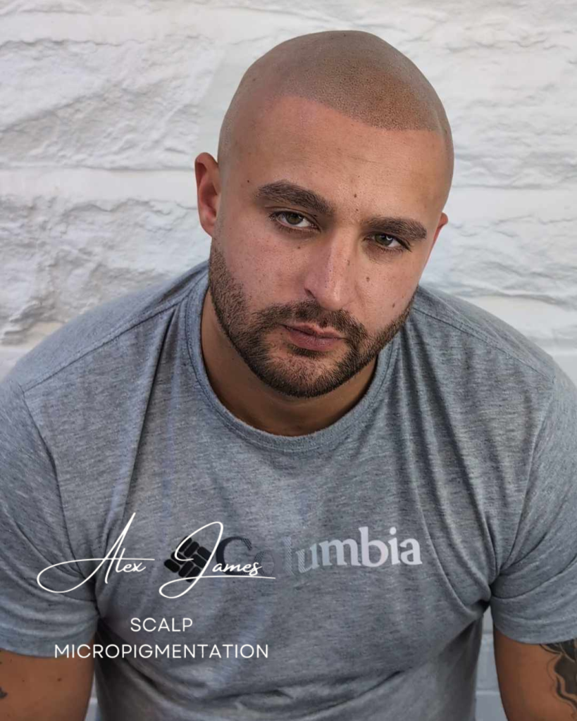 Professional scalp micropigmentation results full head coverage Manchester specialist
