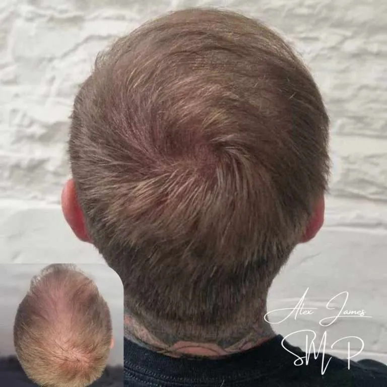 Crown thinning scalp micropigmentation before after results Manchester specialist