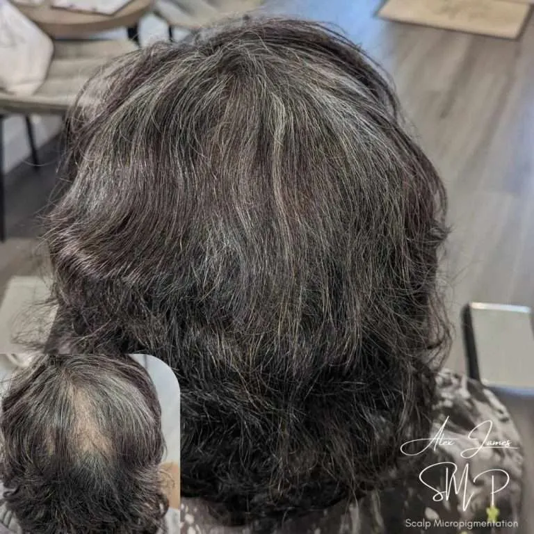 Crown thinning scalp micropigmentation before after results Manchester specialist