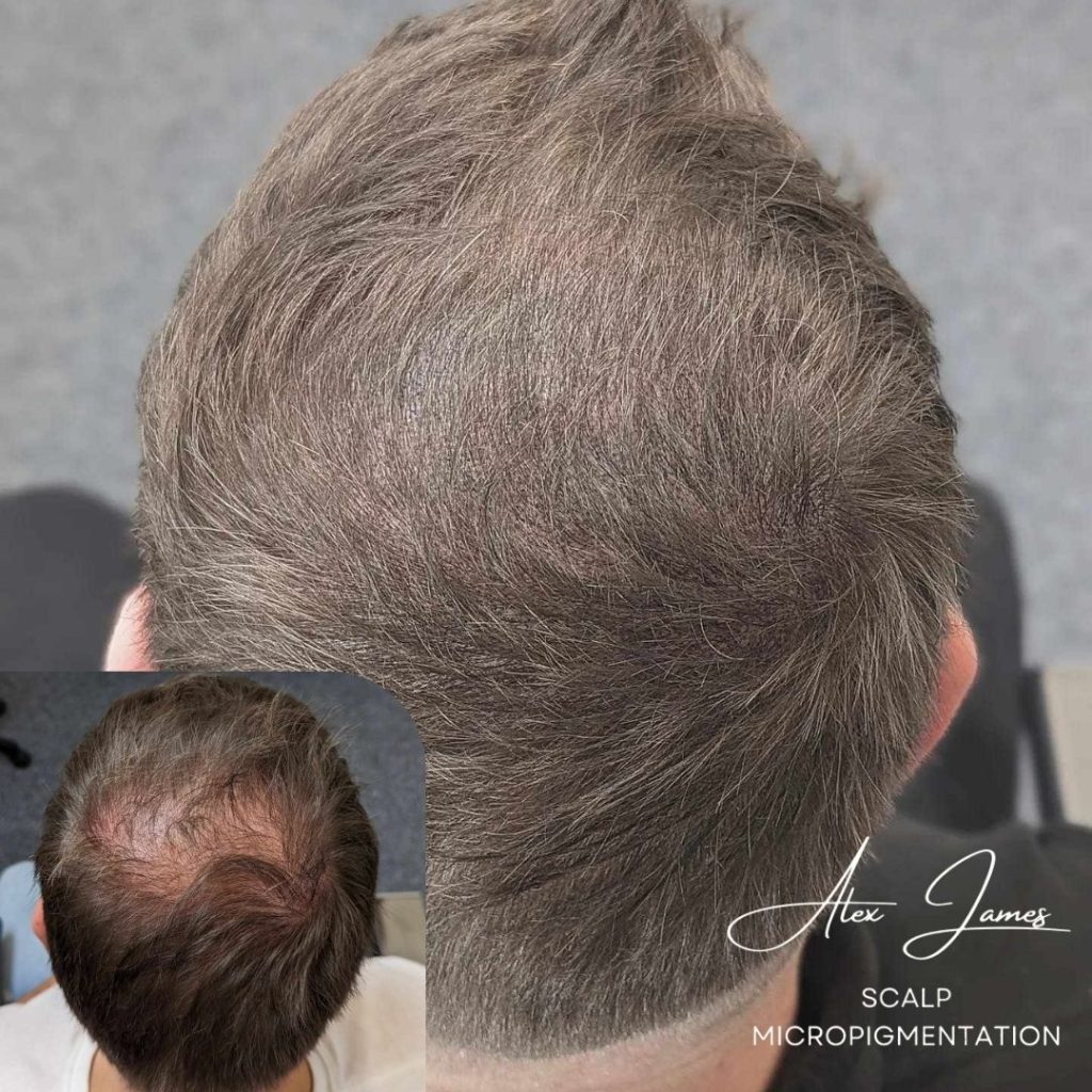 Thinning hair SMP before and after crown Manchester