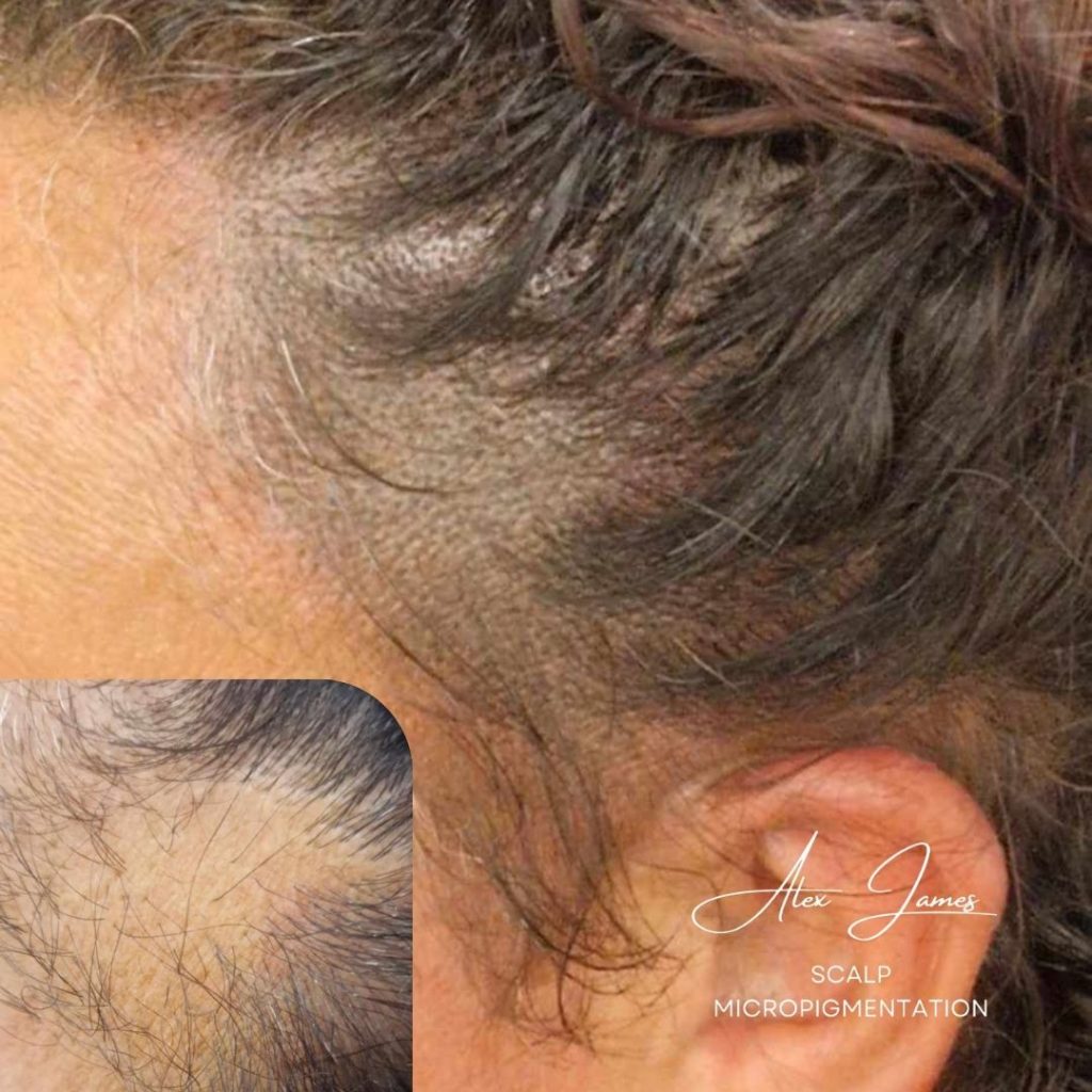Female scalp micropigmentation before and after Manchester