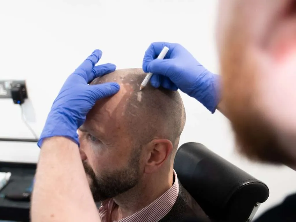 Scalp micropigmentation treatment in progress full head coverage Manchester clinic