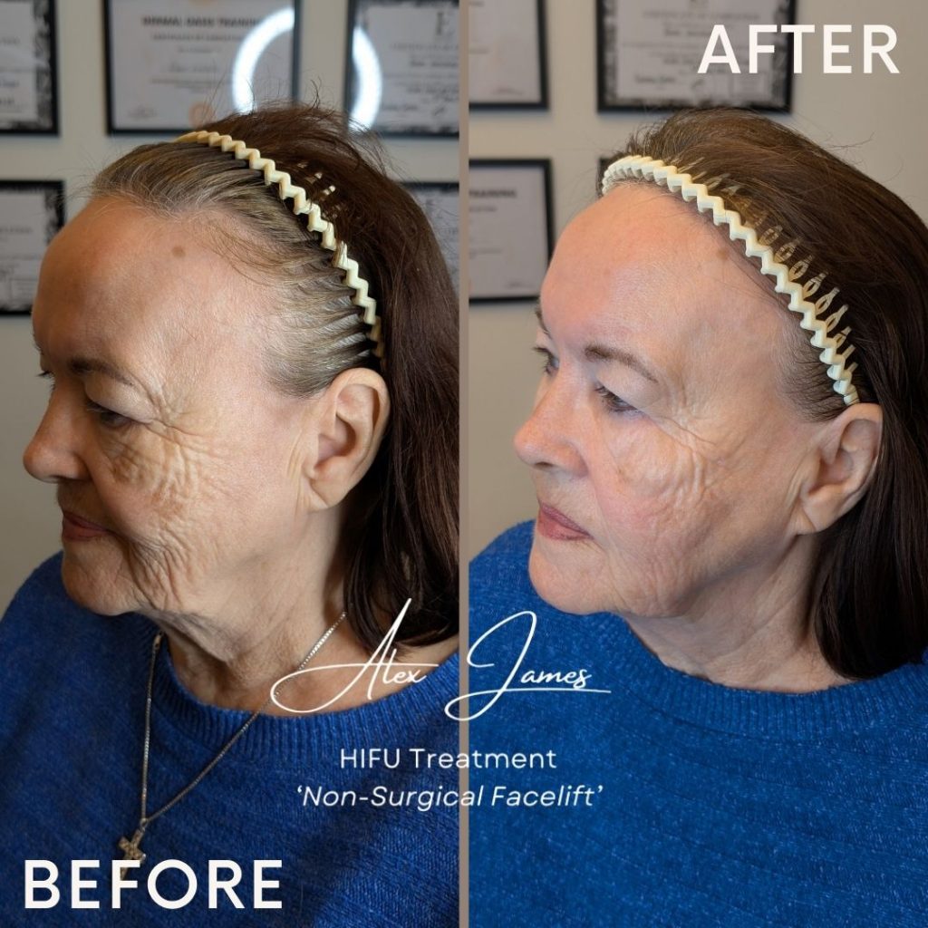 HIFU skin tightening before and after treatment results Manchester clinic