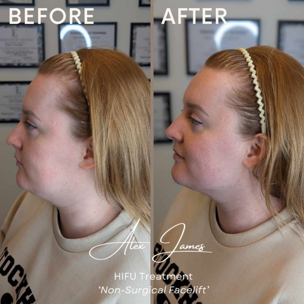 HIFU skin tightening before and after treatment results Manchester clinic