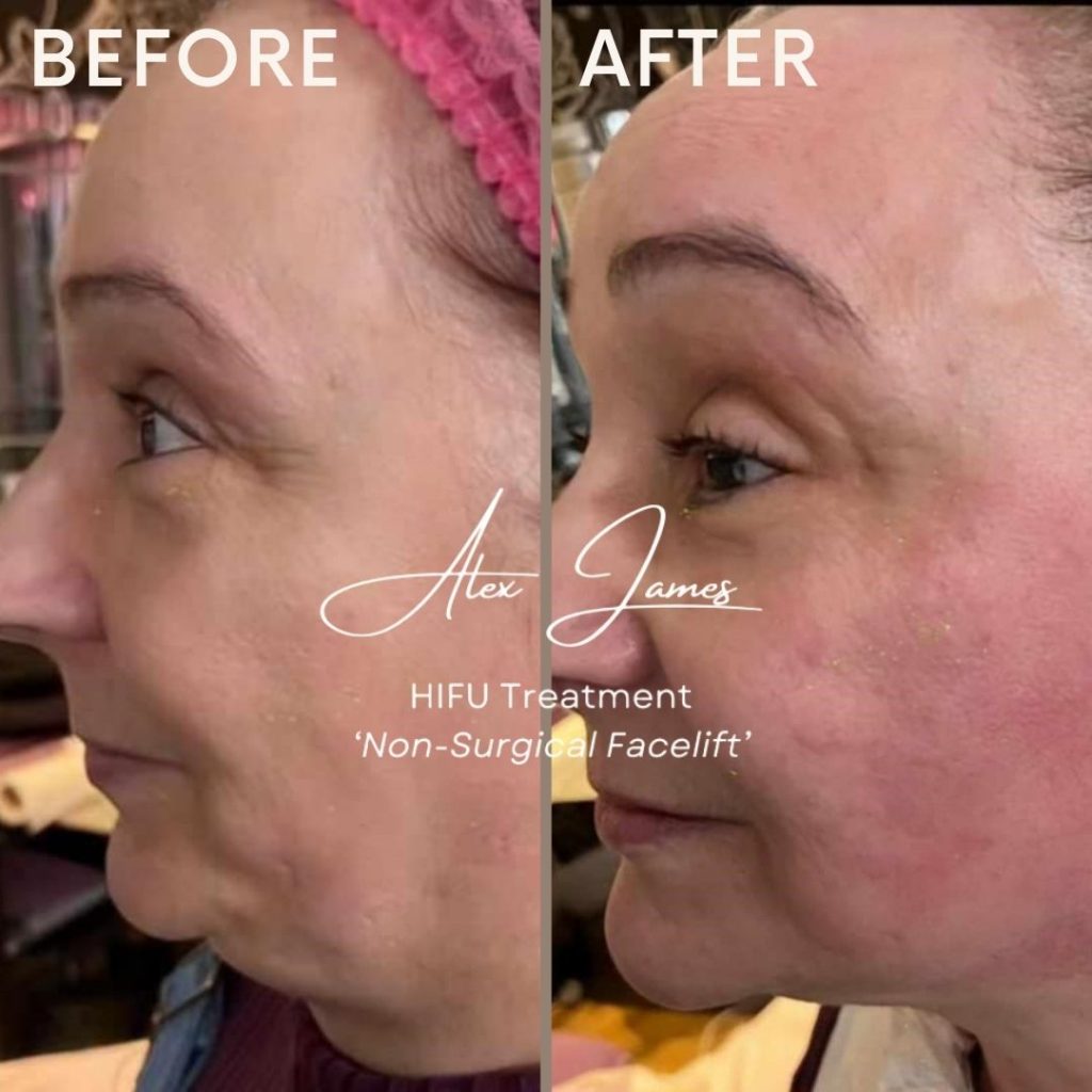 HIFU skin tightening before and after treatment results Manchester clinic