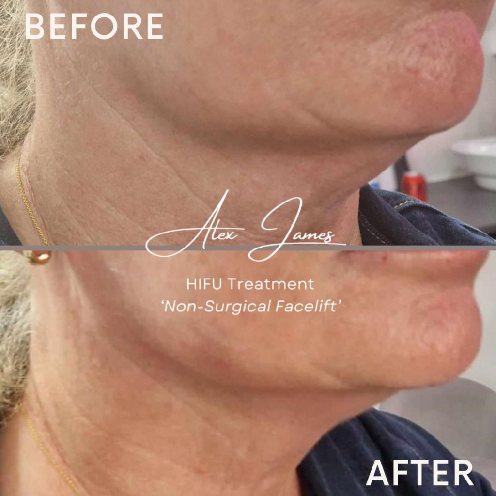 HIFU skin tightening before and after treatment results Manchester clinic