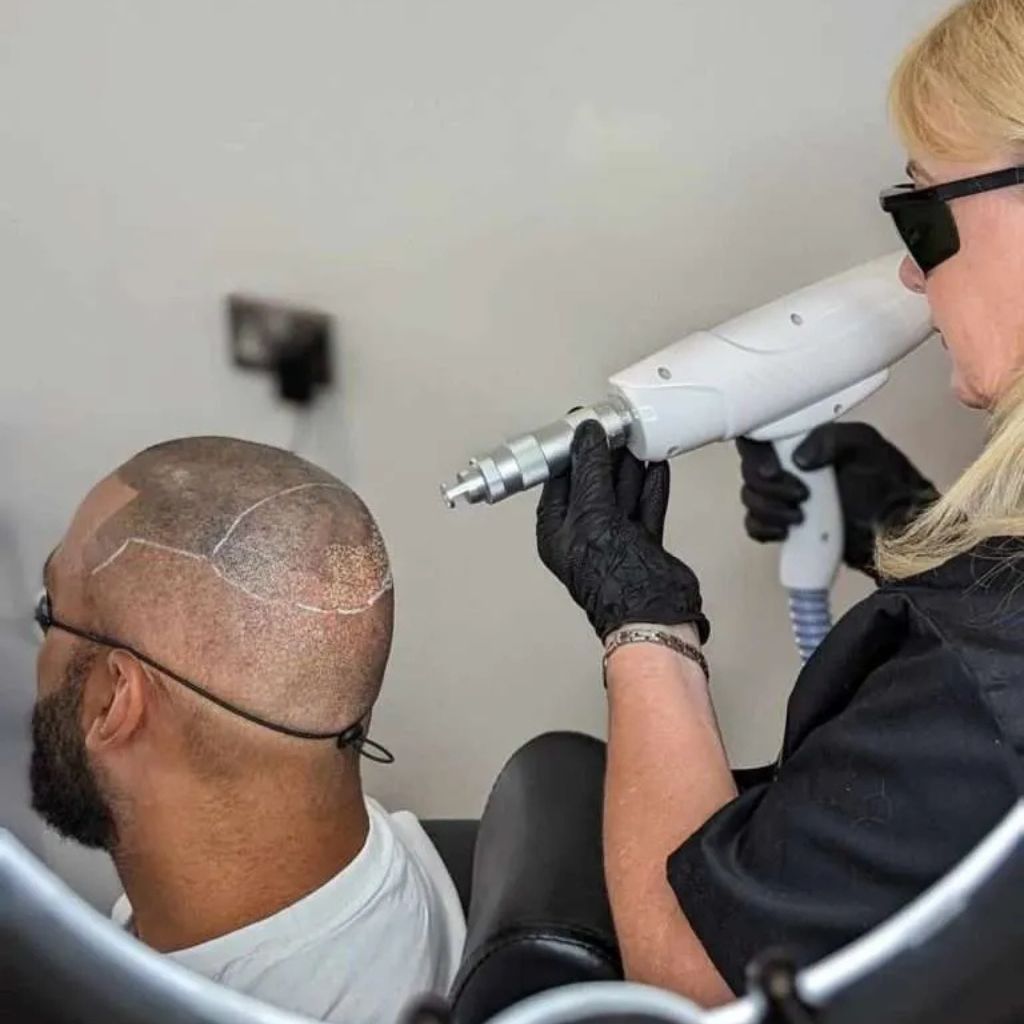 Laser smp removal treatment in progress Alex James Manchester clinic