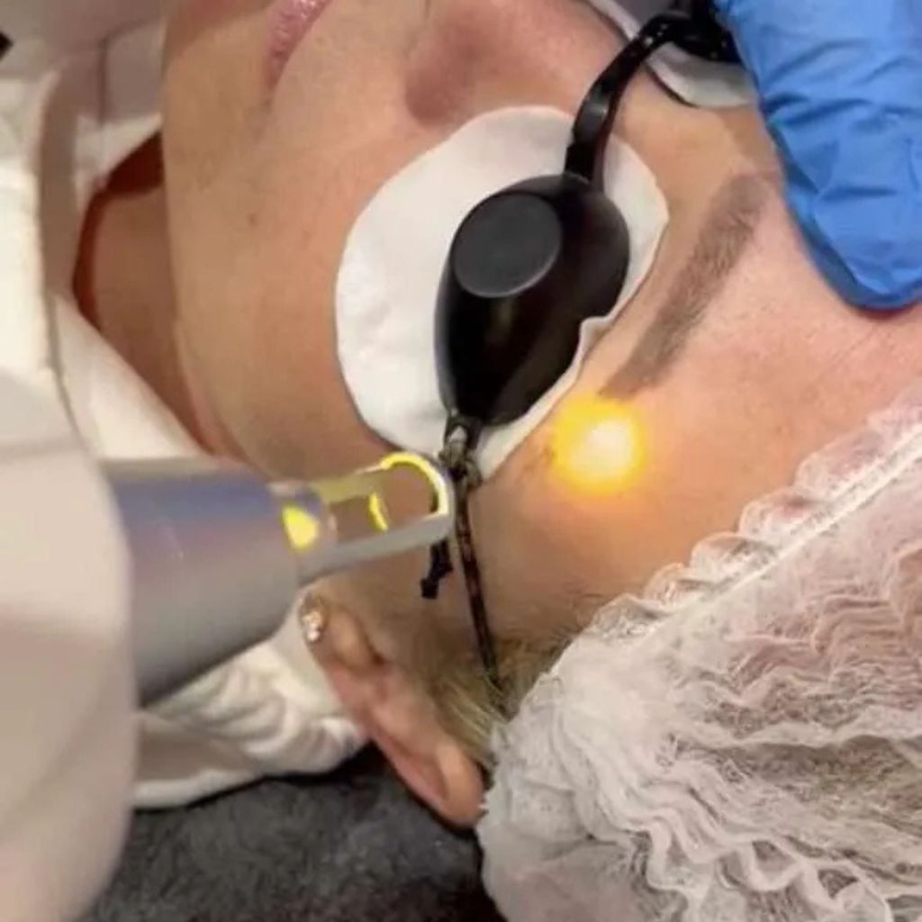 Laser pmu removal treatment in progress Alex James Manchester clinic