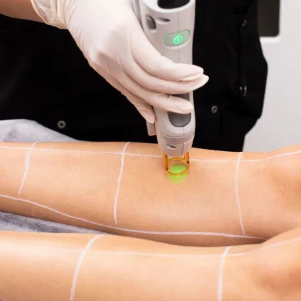 Laser hair removal treatment in progress Alex James Manchester clinic