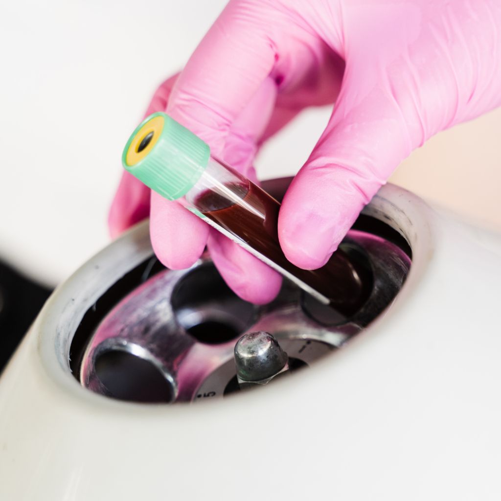 Advanced PRP treatment equipment Alex James Manchester clinic specialist tools