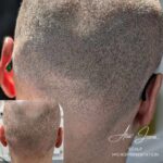 Hair transplant scar camouflage SMP before after Manchester specialist clinic