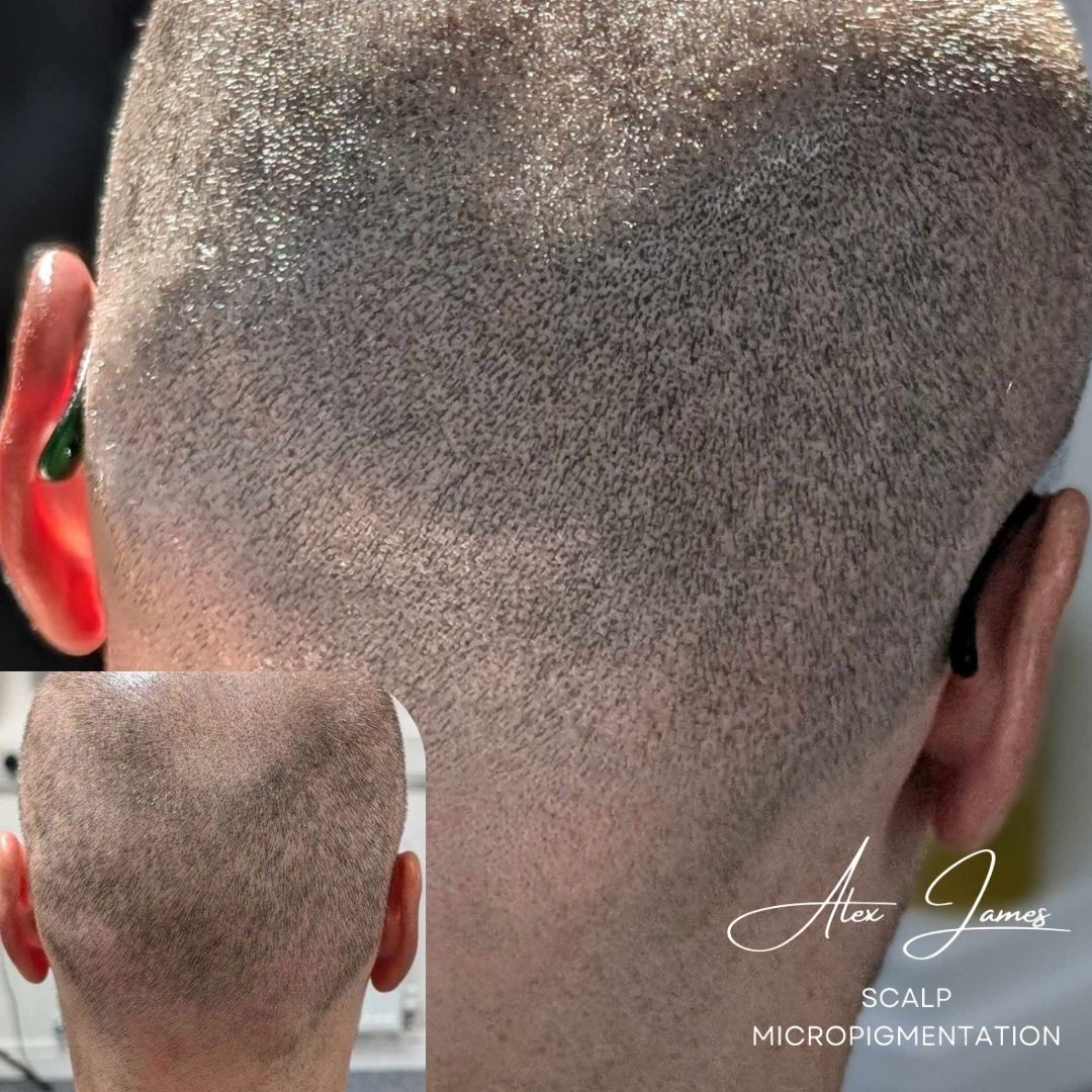 Hair transplant scar camouflage SMP before after Manchester specialist clinic