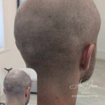 Hair transplant scar camouflage SMP before after Manchester specialist clinic