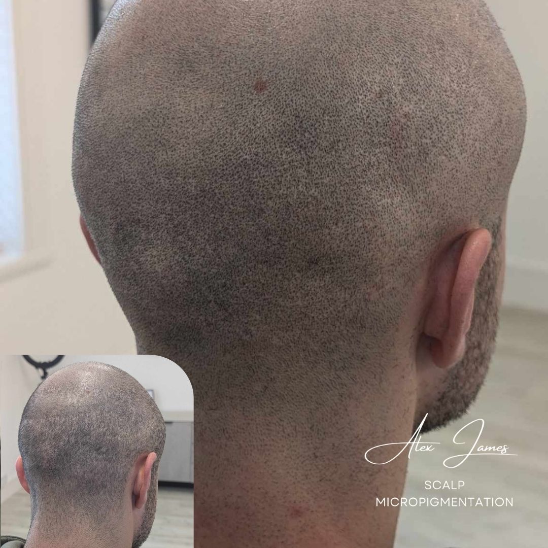 Hair transplant scar camouflage SMP before after Manchester specialist clinic
