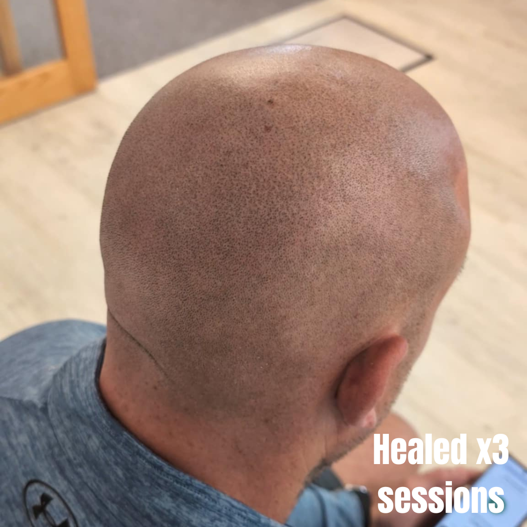 Professional scalp micropigmentation results full head coverage Manchester specialist