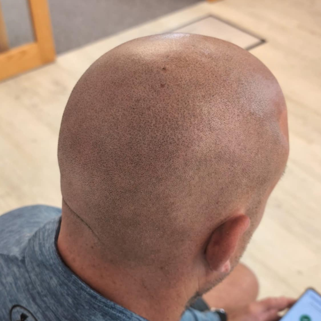 Professional scalp micropigmentation results full head coverage Manchester specialist