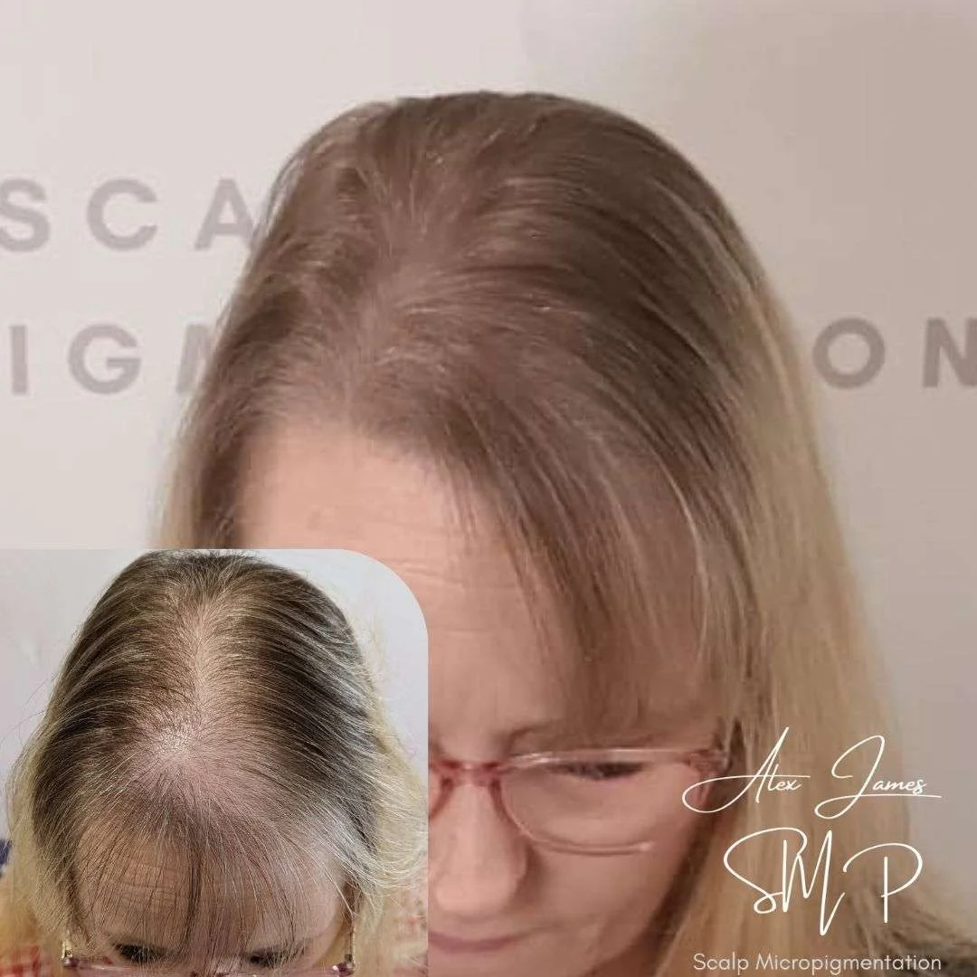 Female hair loss scalp micropigmentation before after treatment Manchester women specialist