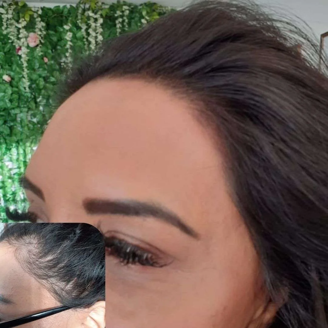 Female hair loss scalp micropigmentation before after treatment Manchester women specialist