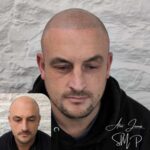 Full head scalp micropigmentation before and after results Manchester specialist clinic