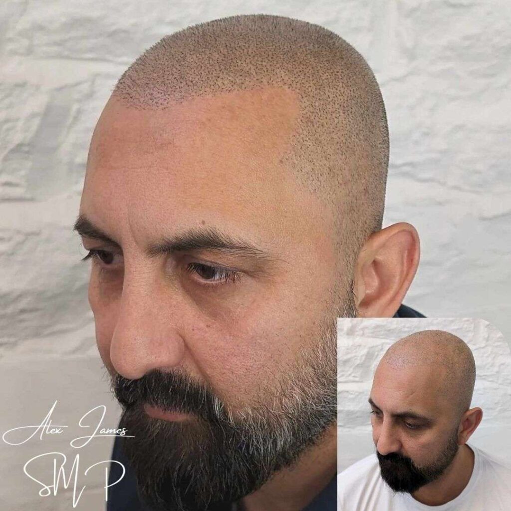 Full head scalp micropigmentation before and after results Manchester specialist clinic