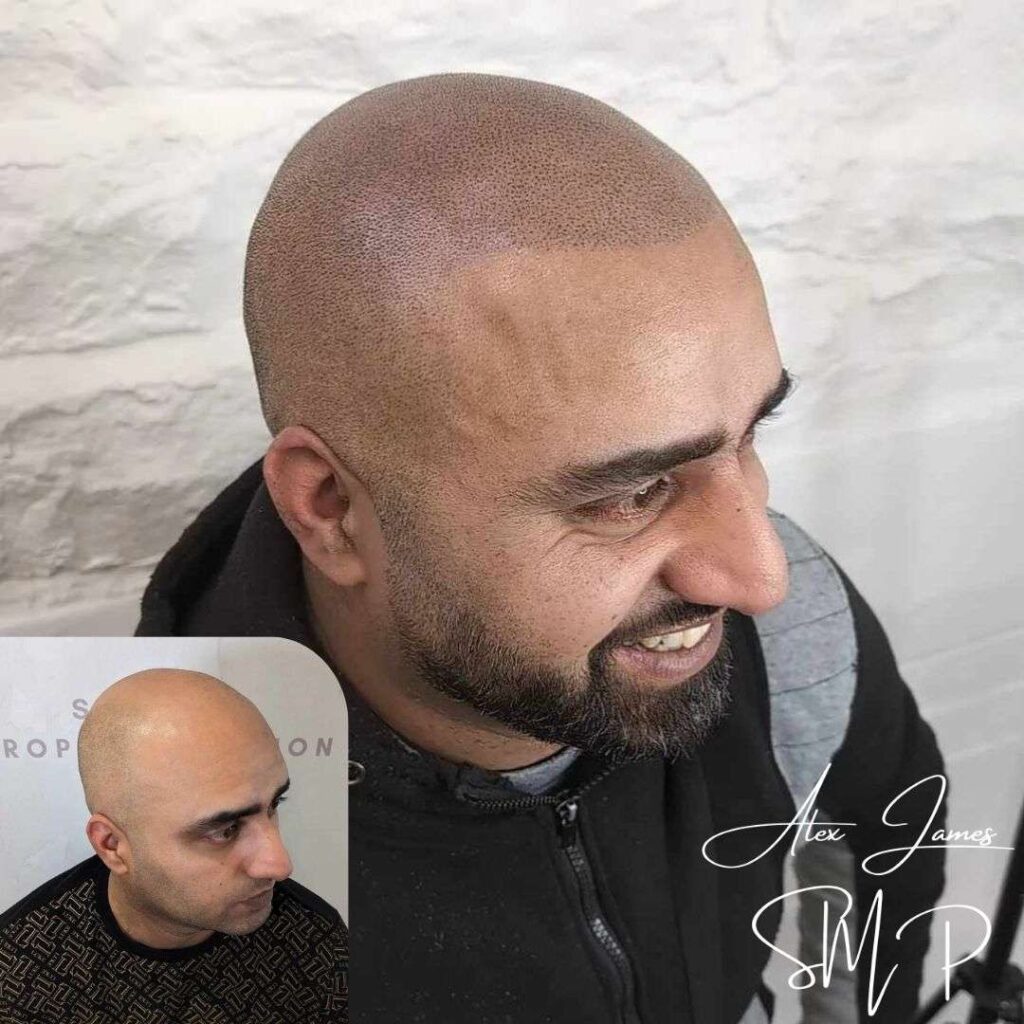 Full head scalp micropigmentation before and after results Manchester specialist clinic