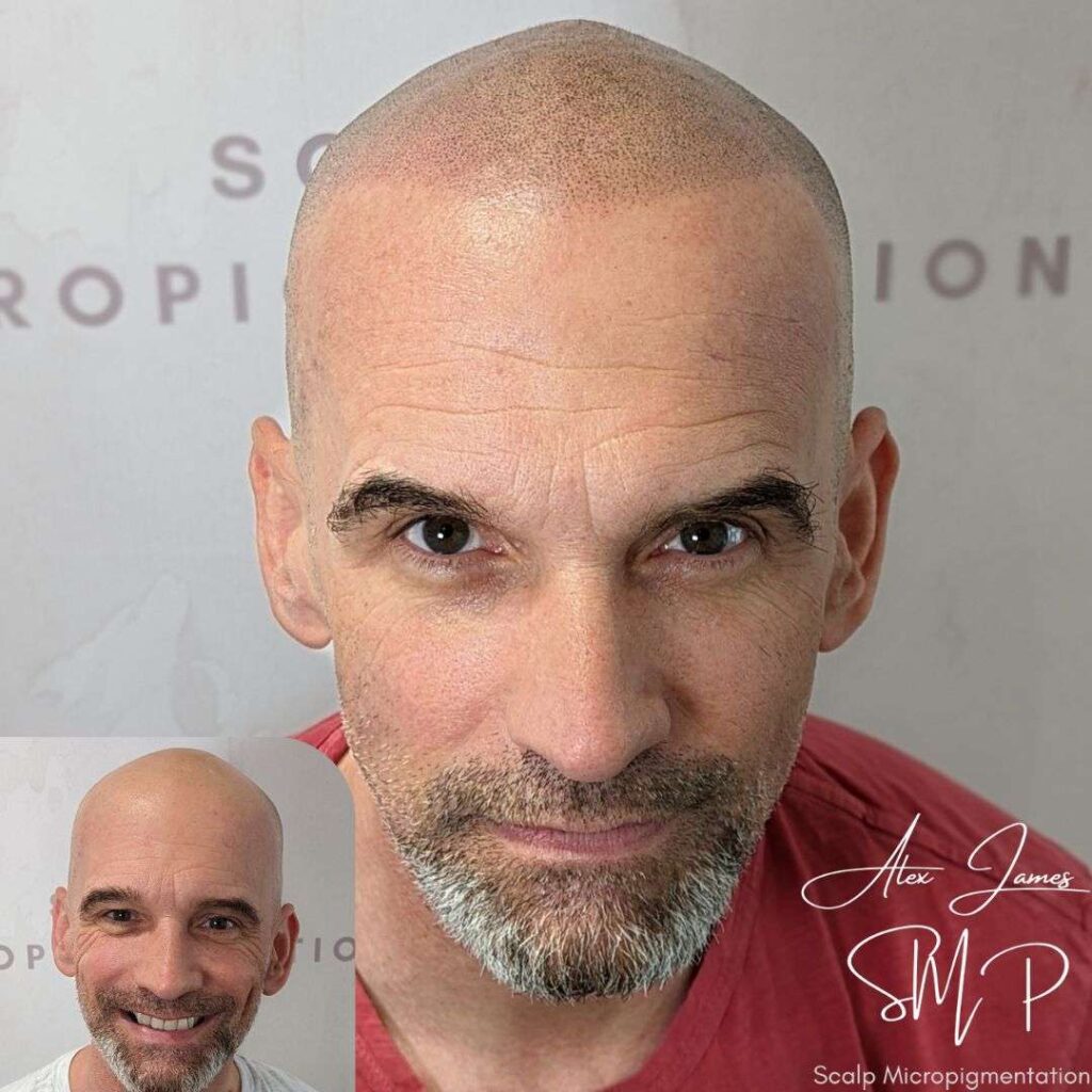 Full head scalp micropigmentation before and after results Manchester specialist clinic
