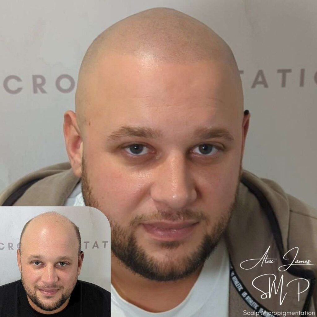 Full head scalp micropigmentation before and after results Manchester specialist clinic