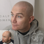 Full head scalp micropigmentation before and after results Manchester specialist clinic