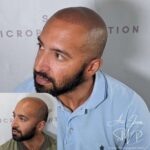 Full head scalp micropigmentation before and after results Manchester specialist clinic
