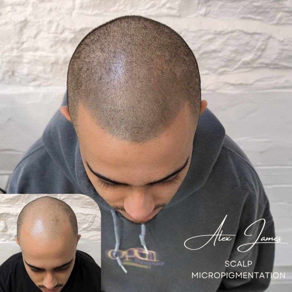 Full head scalp micropigmentation before and after results Manchester specialist clinic