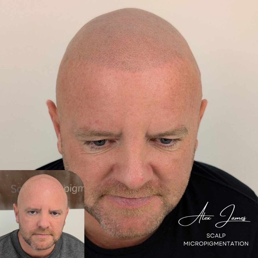 Full head scalp micropigmentation before and after results Manchester specialist clinic