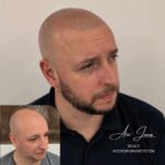 Full head scalp micropigmentation before and after results Manchester specialist clinic