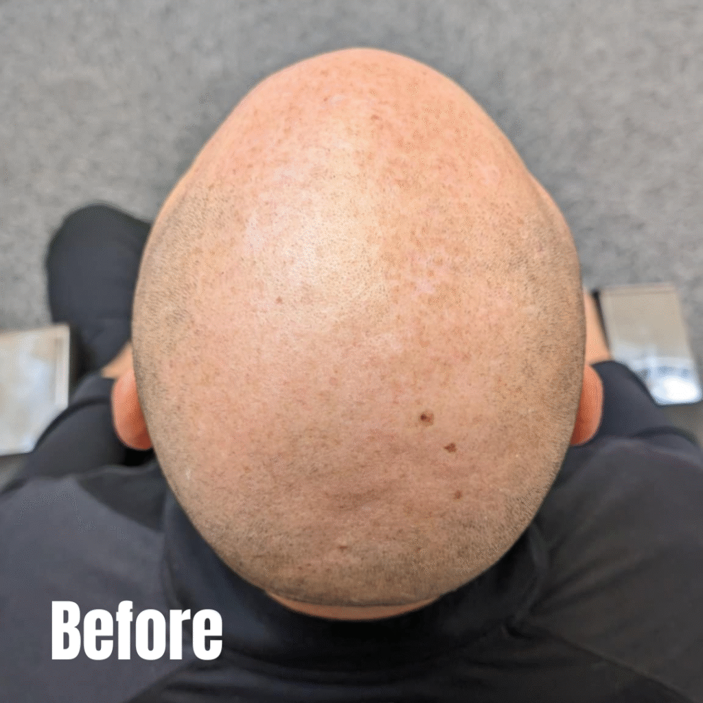 Male pattern baldness before scalp micropigmentation treatment Manchester clinic