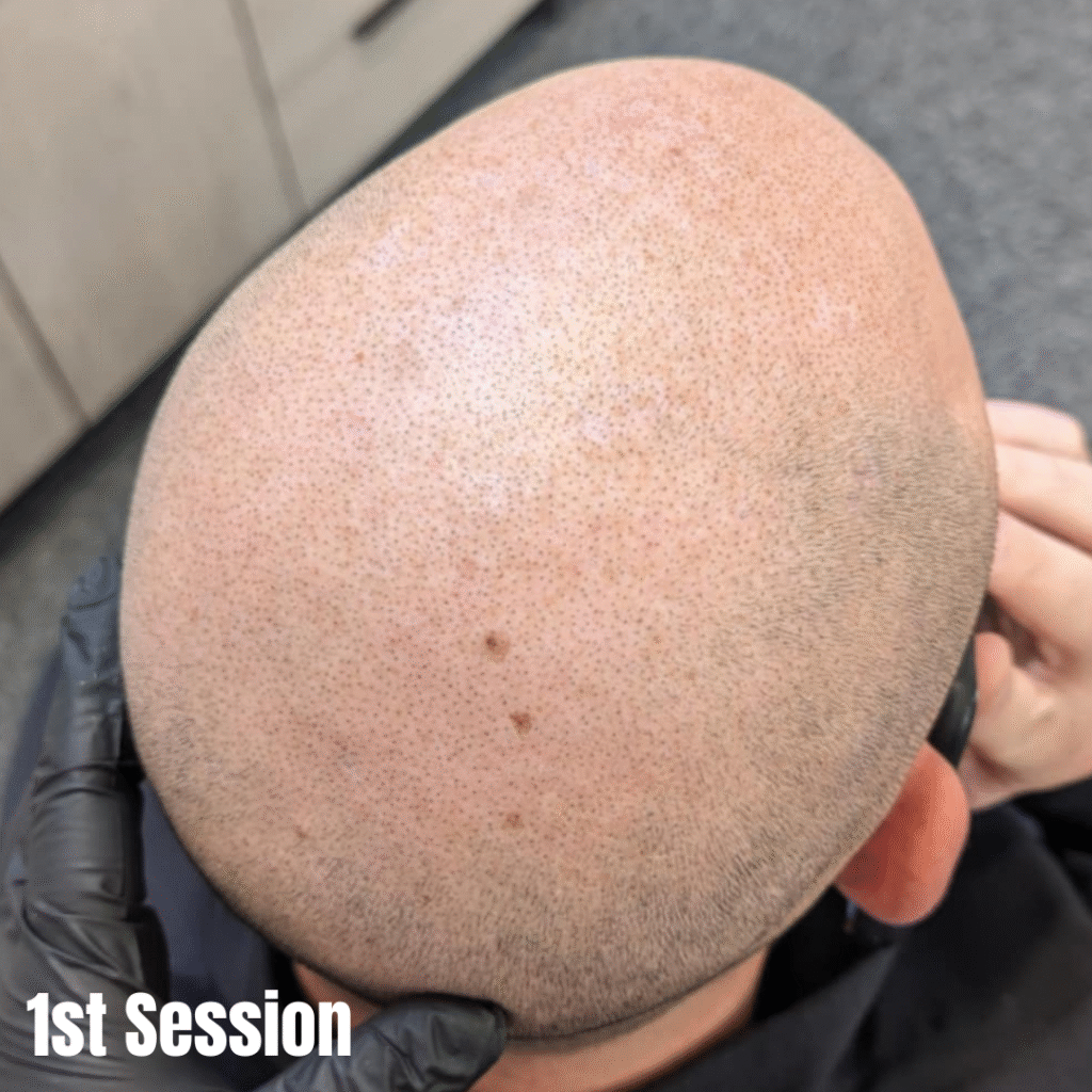 Male pattern baldness before scalp micropigmentation treatment Manchester clinic