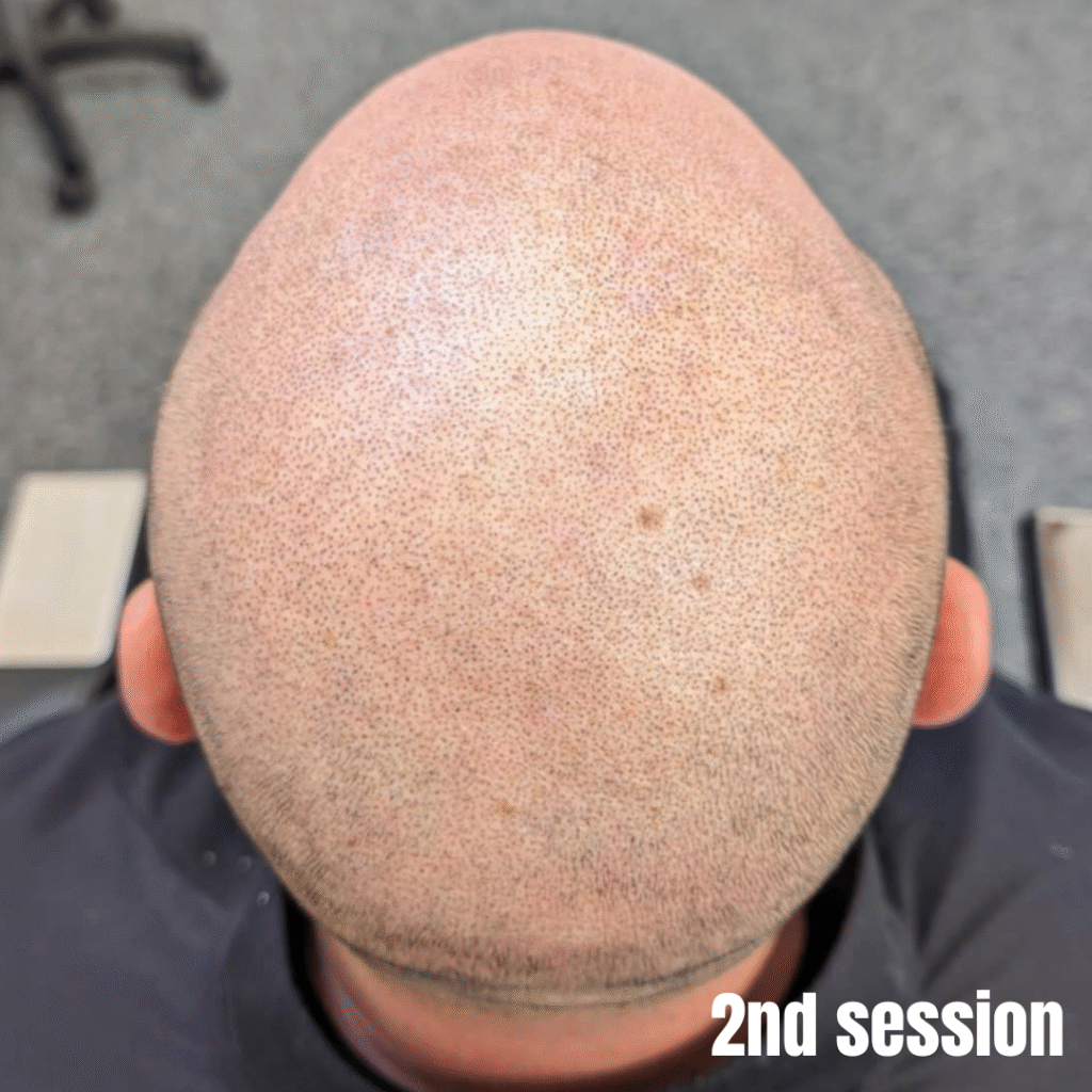 Male pattern baldness before scalp micropigmentation treatment Manchester clinic