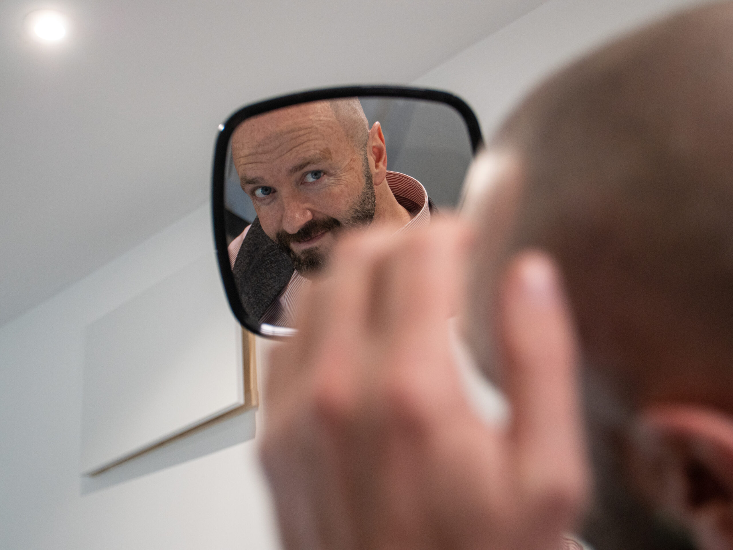 Scalp micropigmentation treatment in progress full head coverage Manchester clinic