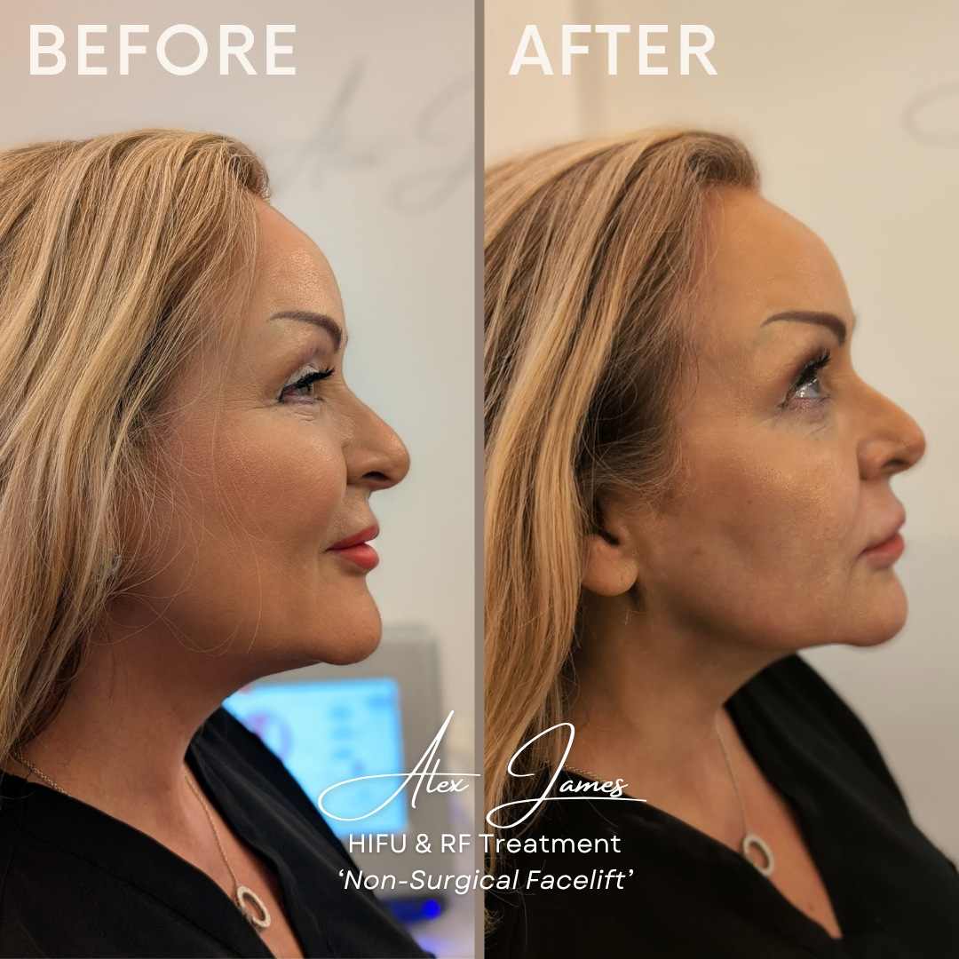 HIFU skin tightening before and after treatment results Manchester clinic