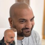 Full head scalp micropigmentation before and after results Manchester specialist clinic