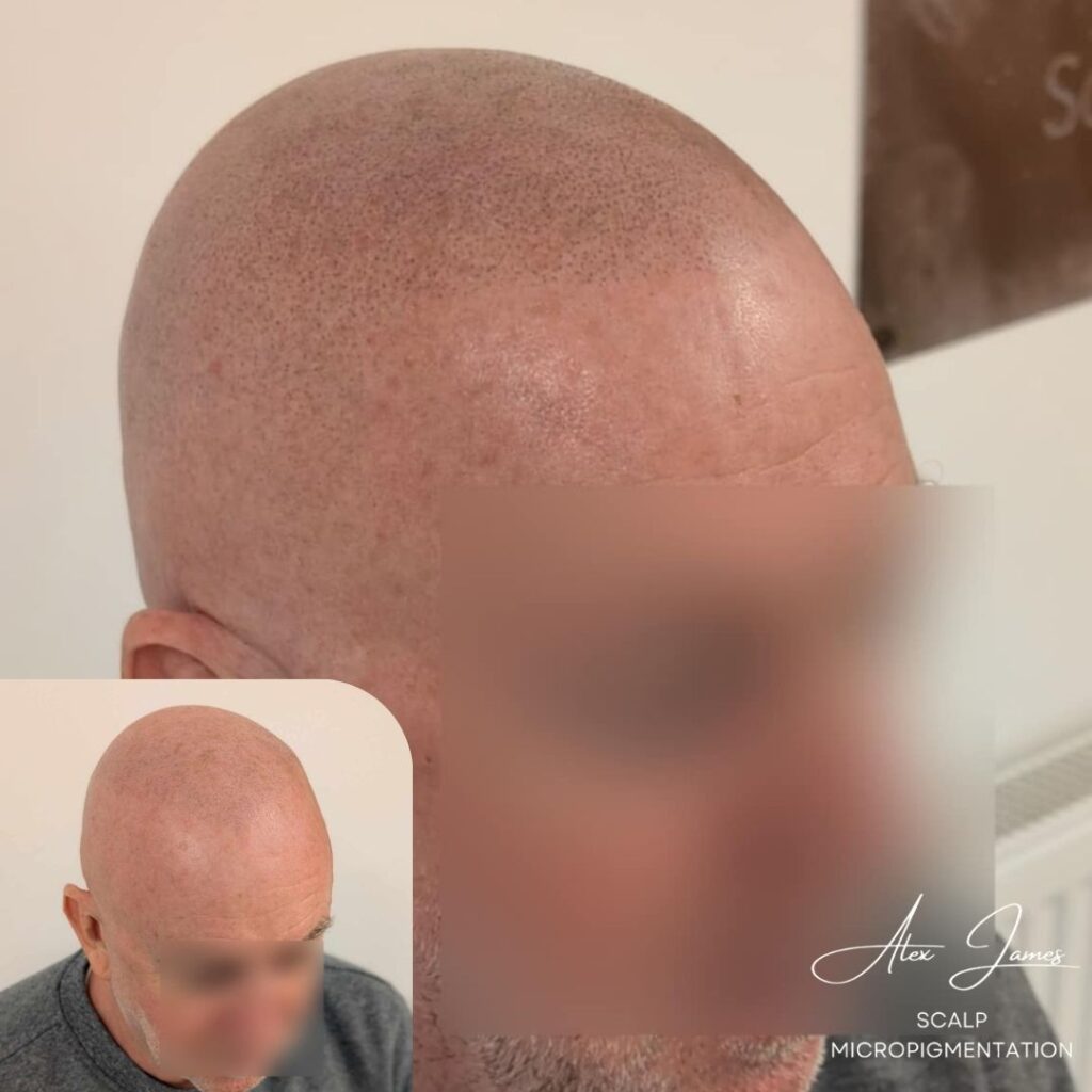 Full head scalp micropigmentation before and after results Manchester specialist clinic