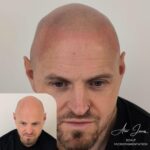 Full head scalp micropigmentation before and after results Manchester specialist clinic