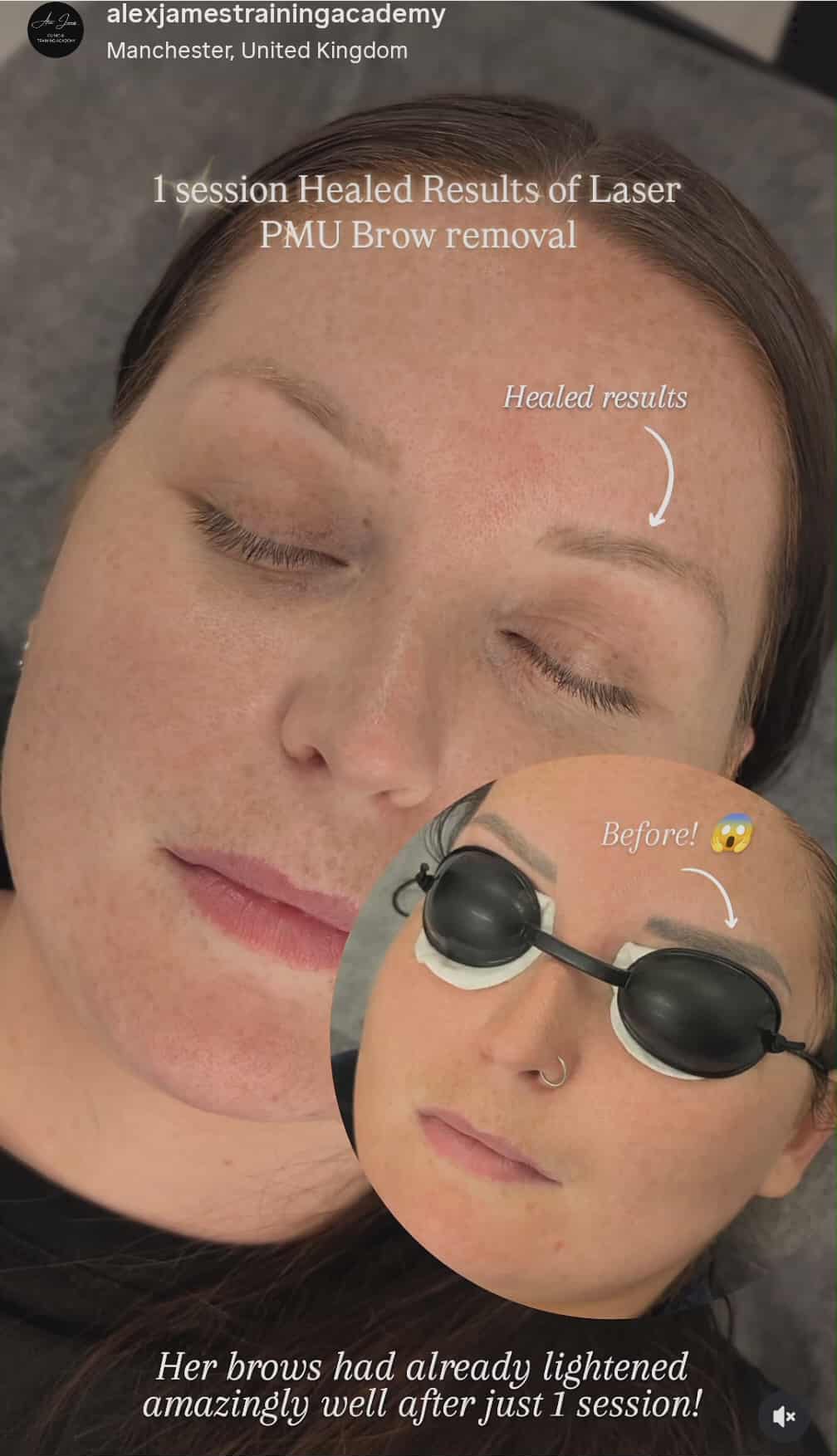 microblading removal Alex James Clinic in Manchester