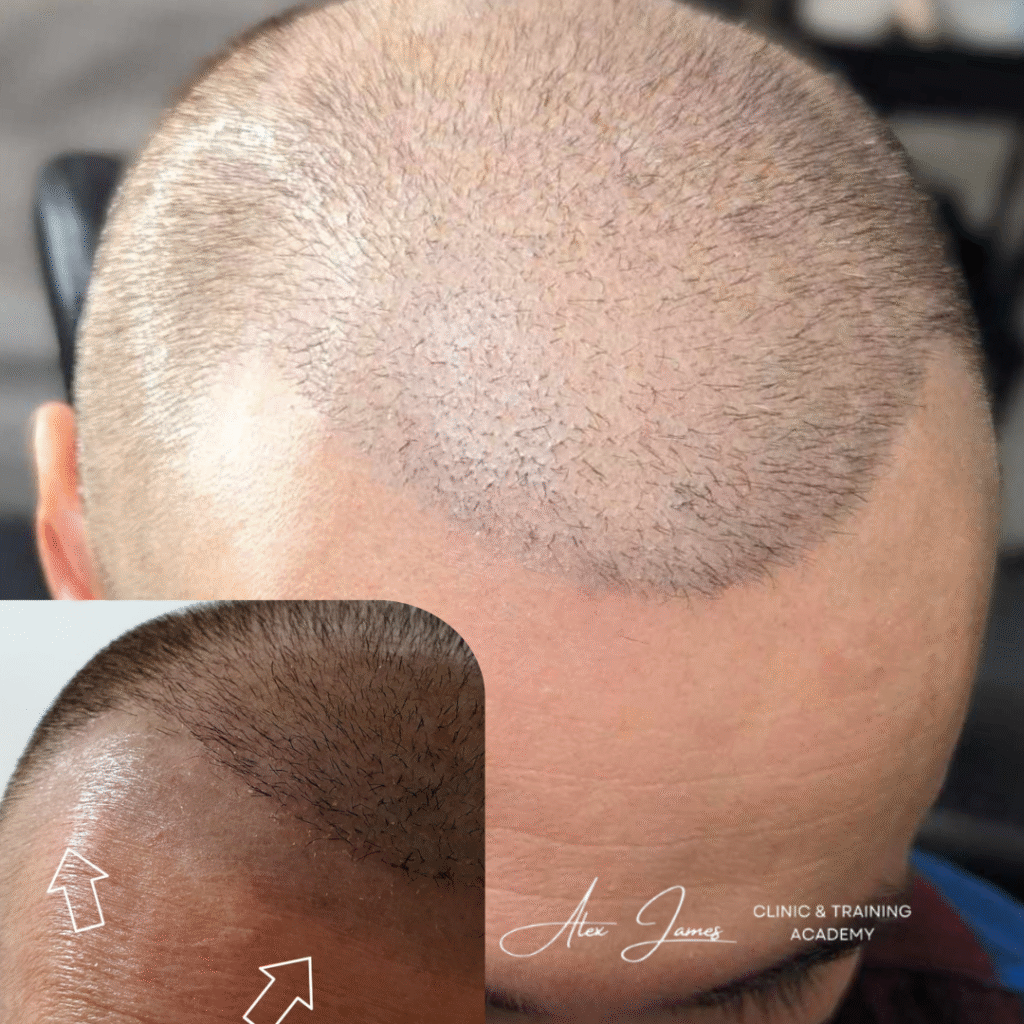 scalp tattoo removal Alex James Clinic Manchester