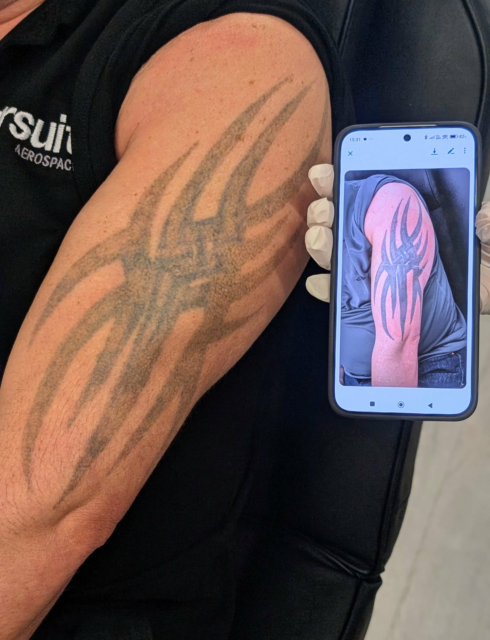 laser tattoo removal treatment Alex James Clinic Manchester