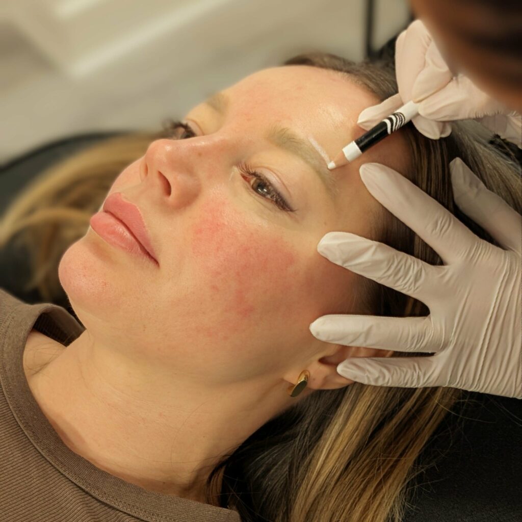 PMU brow removal Alex James Clinic